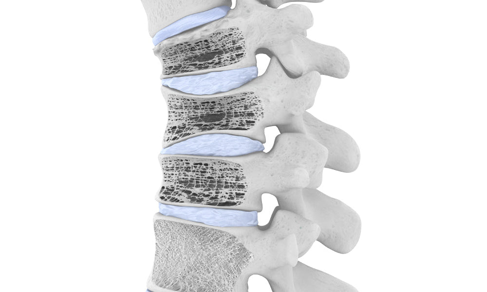 Spinal Osteoporosis